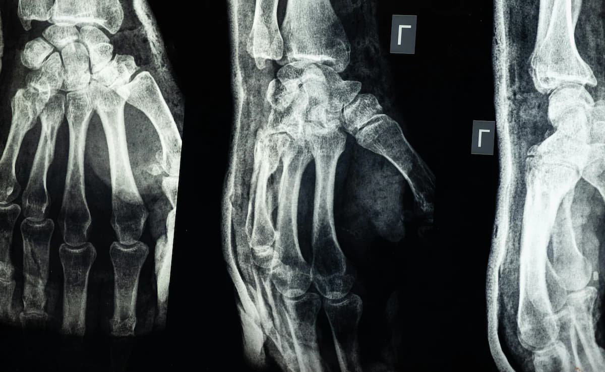 Chinese Scientists Develop “Bone Glue” That Heals Fractures in Minutes